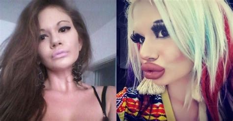22 Yo Bulgarian Girl Gets 17 Acid Injections For Biggest Lips And Look Like A Barbie Doll