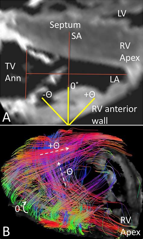 A Anterior Cmr View Of A Normal Right Ventricle Rv Illustrating The