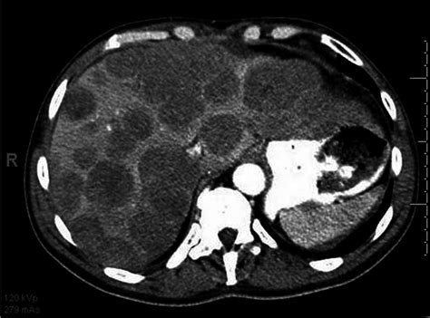 Diffuse Large B Cell Lymphoma Causing Acute Liver Failure A Rare Case