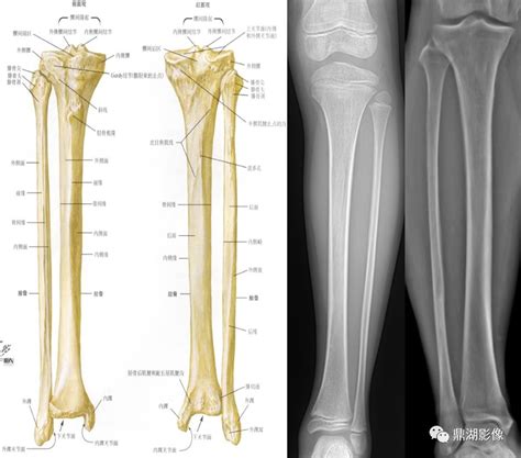 四肢长骨解剖及常见疾病的影像学表现胫骨