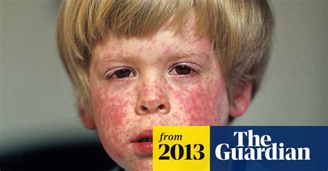 Measles Outbreaks Hit 18 Year High As Effects Of Mmr Scandal Are Felt