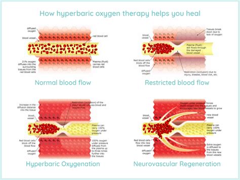 How Does Hyperbaric Oxygen Therapy Heal Wounds Hyperbaric Healing