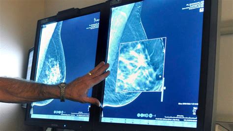 mammogram guidelines now consider women s personal values not just age risk ctv news