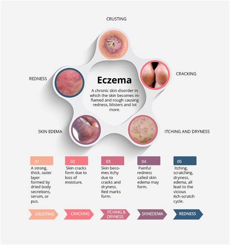 Atopic Dermatitis Eczema Infographic Interesting Facts How To
