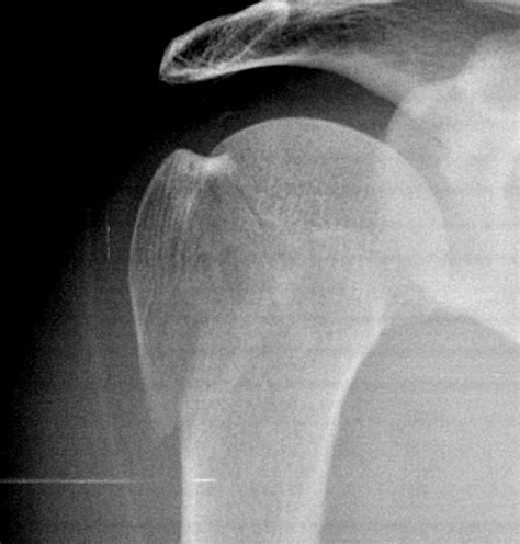 Proximal Humeral Fracture Greater Tuberosity Image Radiopaedia Org