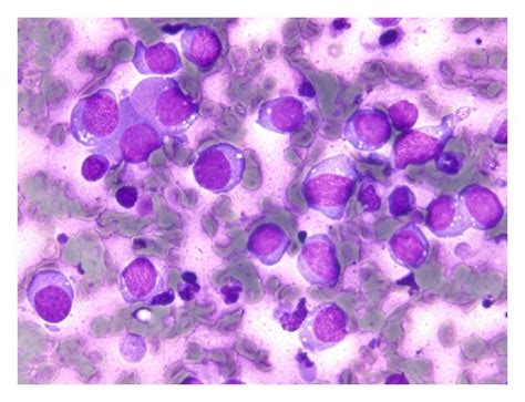 Hemacolor Stained Smear Showing Cells Bearing Basophilic Cytoplasm