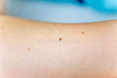 A Birthmark Or A Mole On A Woman Skin Stock Photo Image Of Female