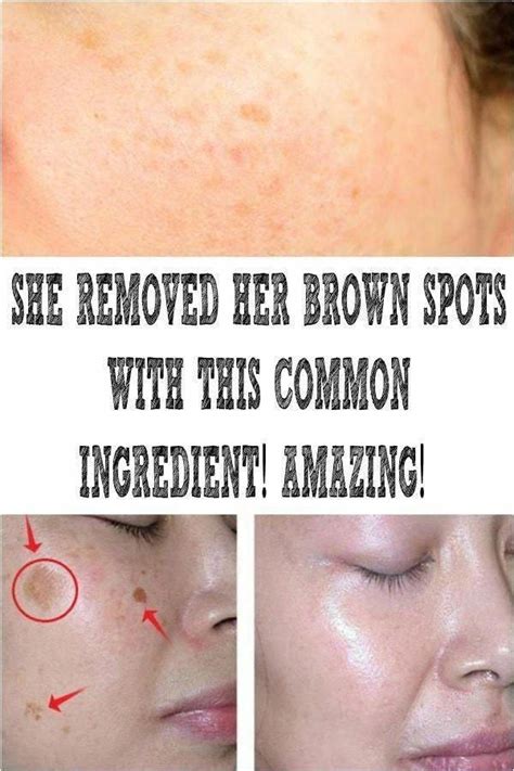 How To Get Rid Of Brown Spots On Face Naturalhairproducts