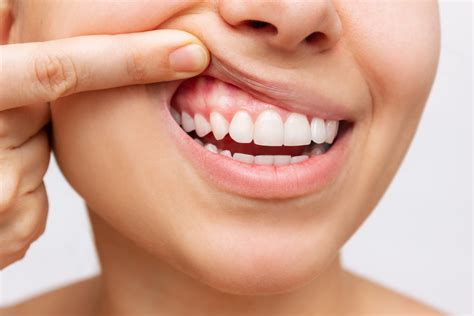 5 Reasons To Care For Your Gum Health Carolinasdentist