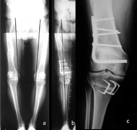 Sixty Five Year Old Patient Presenting With Medial Tibio Femoral