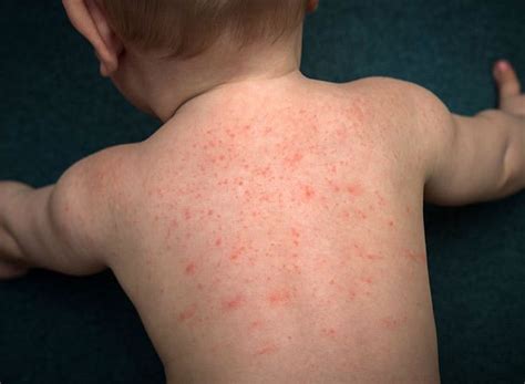 D Austin Hill Measles Symptoms In Toddlers