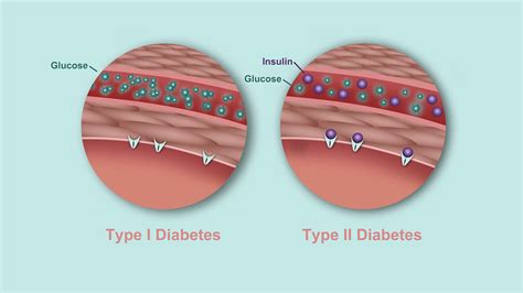 What's the Difference Between Type 1 and Type 2 Diabetes? | Diabetes ...