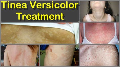 Top 10 Tinea Versicolor Treatment Options That Really Work Naturally