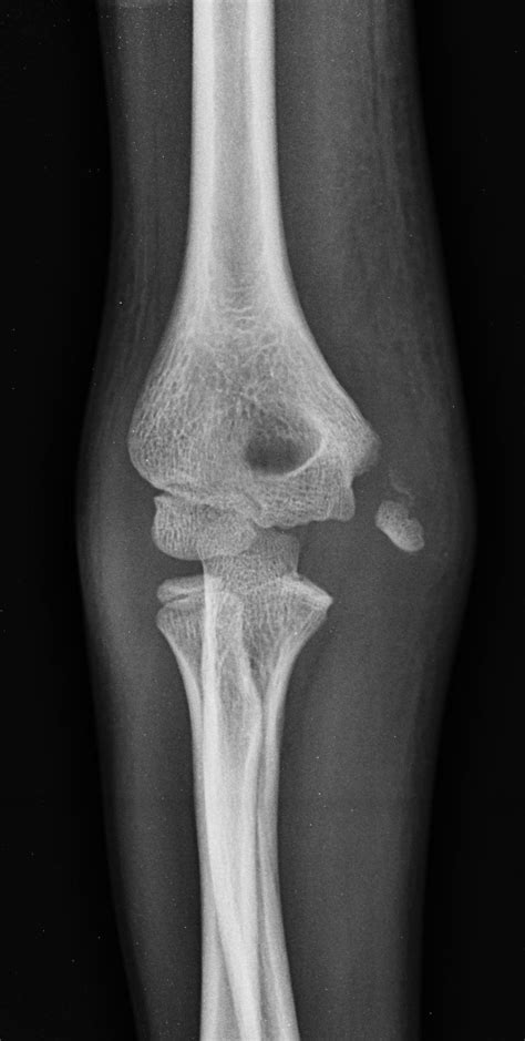 Medial epicondyle fractures represent almost all epicondyle fractures and occur when there is avulsion of the medial epicondyle. Medial epicondyle fracture | Image | Radiopaedia.org