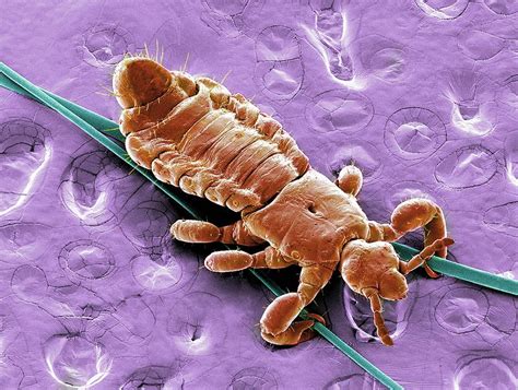 Head Louse Photograph By Karsten Schneiderscience Photo Library