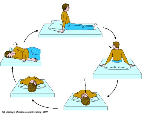 Epley Crp Maneuver For Bppv