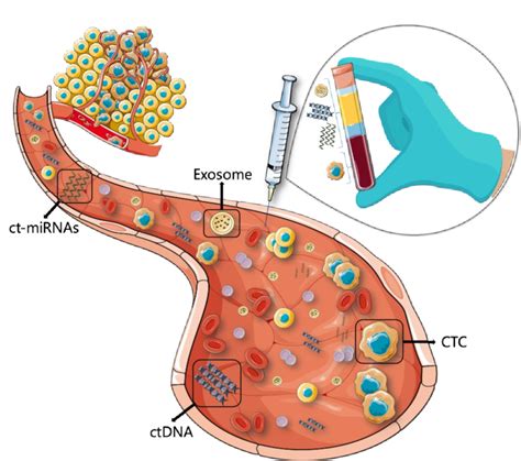 A Schematic View Of Liquid Biopsy Blood Collected From Cancer Patients