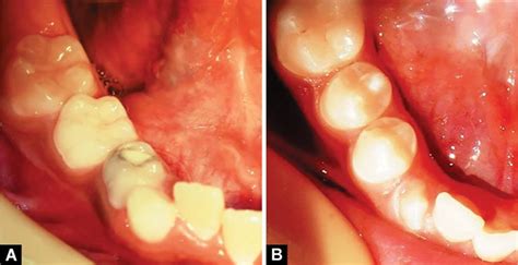 Conservative Treatment Of Dentigerous Cyst Favoring The Normal Eruption