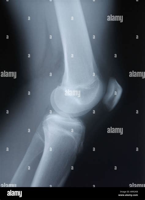 Normal Lateral X Ray Of Juvenile Knee Stock Photo Alamy