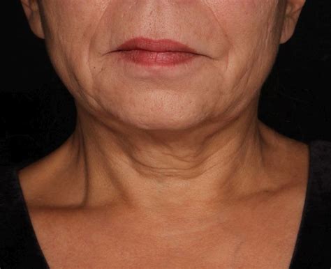 Picosecond 755 Nm Laser Found Effective For Neck Rejuvenation Mdedge