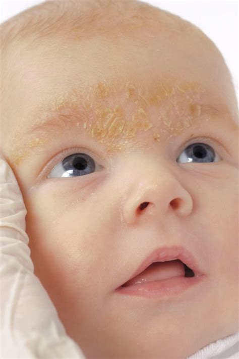 Baby Rashes Remedies Hiccups Pregnancy