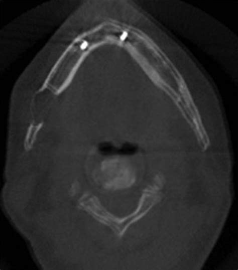 Multimodality Imaging Of Stafne Bone Defect Bmj Case Reports