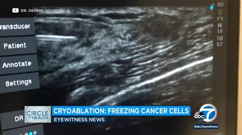 Freezing Away Earlier Stages Of Breast Cancer How Cryoablation Could
