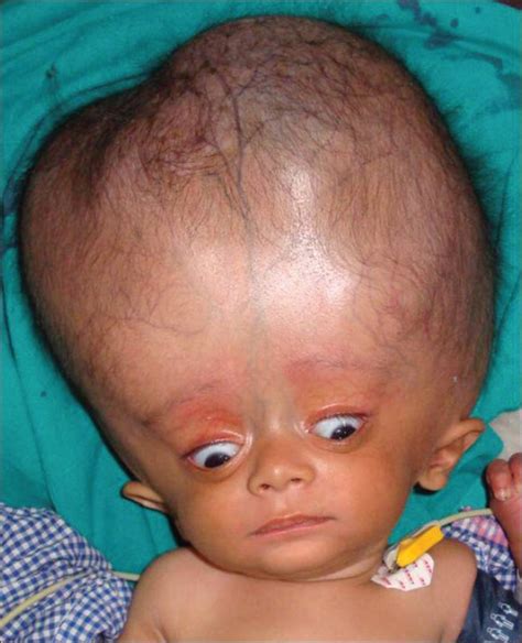 Mother Throws Baby With Unusual Big Head Into Refuse