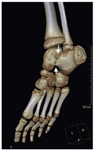 Excision Of Tarsal Coalitions Musculoskeletal Key