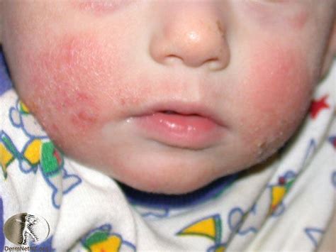 ¿qué Es La Dermatitis Atópica