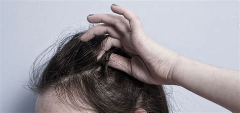 trichotillomania hair pulling disorder human hair exim
