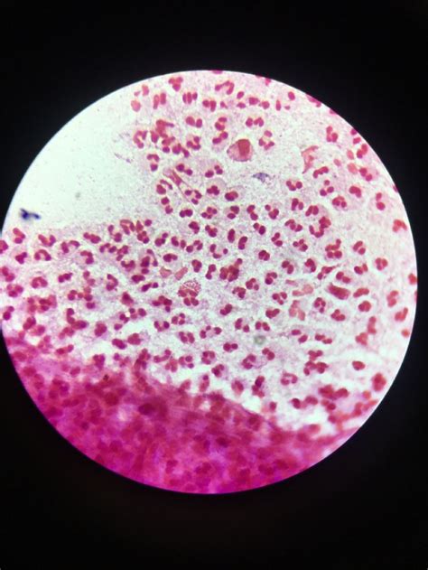 Gram Negative Diplococci Intracellular Microbiología Puntos Microscopio