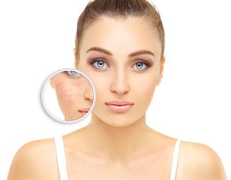Dont Live With Adult Acne Find Out Which Treatment Option Is Best For