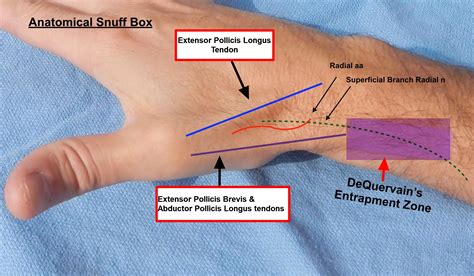 De Quervain S Tenosynovitis Exam Hot Sex Picture