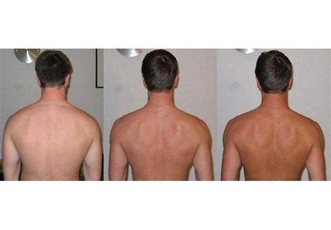 Before And After Melanotan Tanning Therapy Sunless Tanning Results