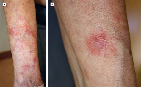 Subacute Cutaneous Lupus Erythematosus Dermatology Jama Dermatology