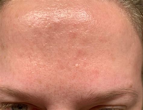 Bumpy Forehead Large Pores Redness Routine Stuff Routine Help
