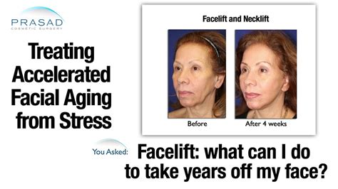 How Extreme Stress Can Affect Facial Aging And Options For Facial