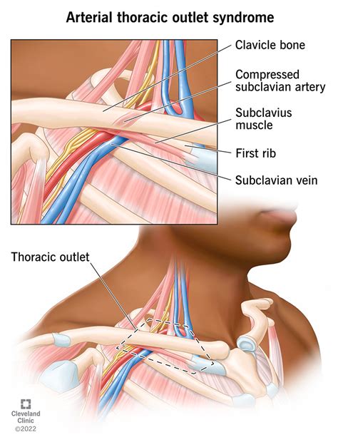 Thoracic Outlet Syndrome Anatomy My Xxx Hot Girl Hot Sex Picture