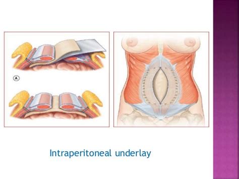 Abdominal Wall Defect Reconstruction