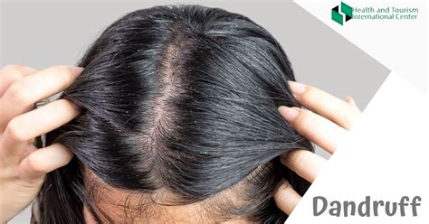 Is Dandruff Contagious And When Should We See A Doctor Hti Centers Medical Tourism Center