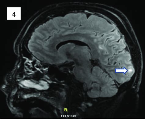 T2 Flair Sagittal Section Of Mri Showing Hyperintense Foci Involving