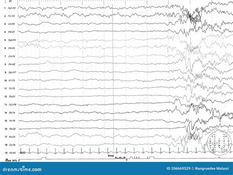 Problems In The Electrical Activity Of The Brainabnormal Eeg Stock