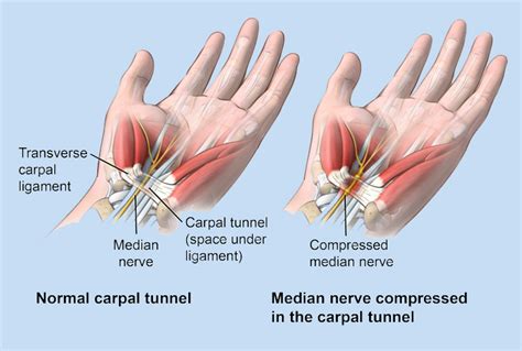 Carpal Tunnel Treatment In Broward And Palm Beach South Florida Hand Center