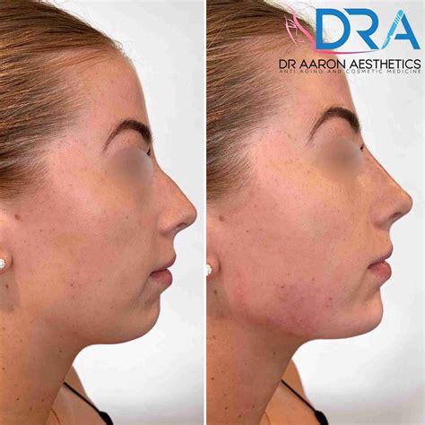 Dermal Fillers Example 18 Dr Aaron Stanes Anti Ageing And Cosmetic