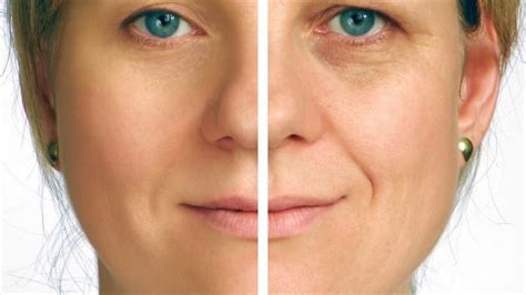 There are many skin conditions which causes white spots. Vitamin Deficiency Small White Spots On Skin / 5 Vitamin ...