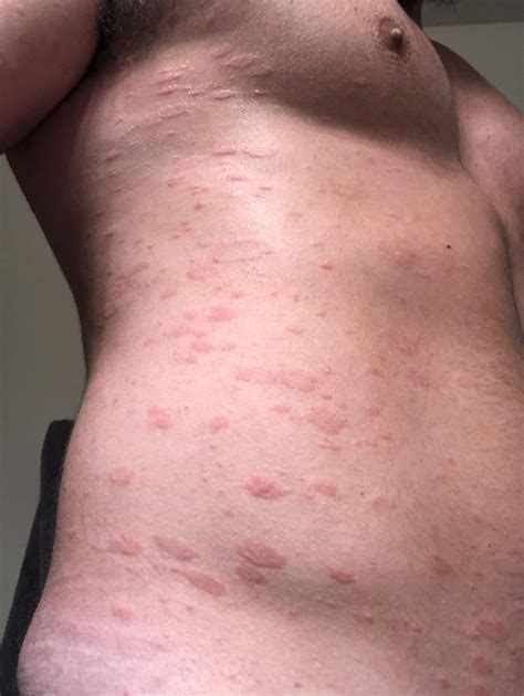 Pityriasis Herald Patch And Pityriasis Rosea Vujevich Dermatology A