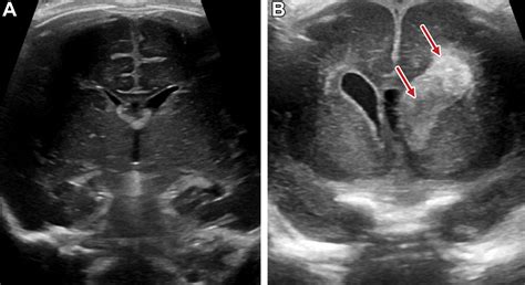 Review Of Neonatal And Infant Cranial Us Radiographics