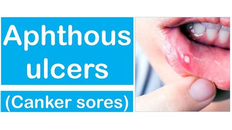 Aphthous Ulcers Fully Explained Video Tutorial Youtube