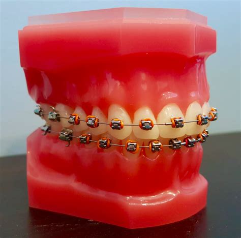Self Ligating Braces At Pearl Align Everything You Should Know About